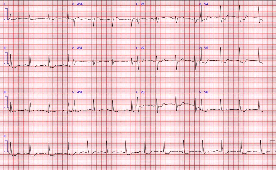 aVR ST elevation ECG
