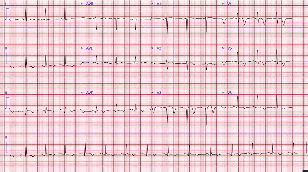 Wellens syndrome ECG