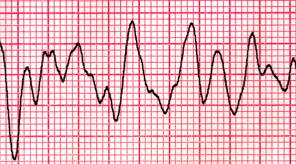 Monomorphic VT ECG