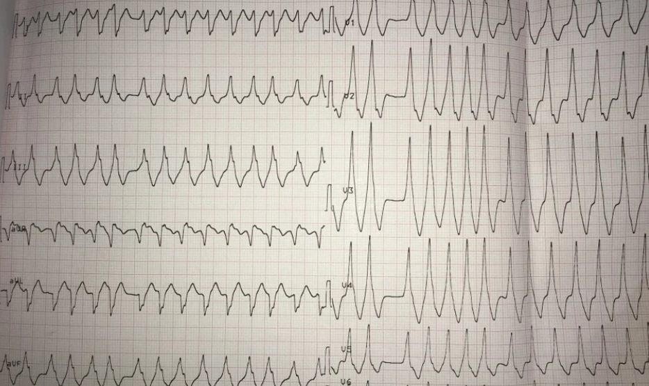 Pre-excited AF ECG