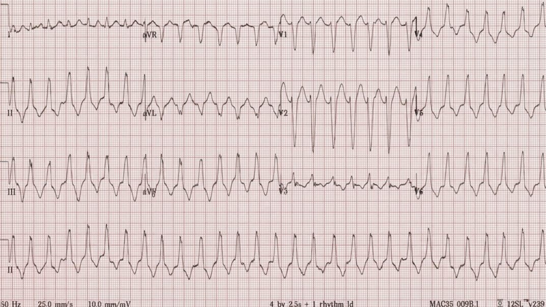 RVOT VT ECG