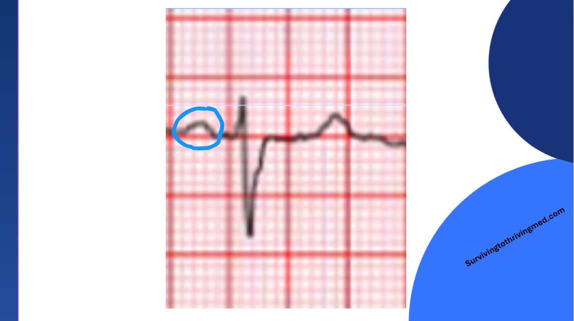 P wave morphology diagram