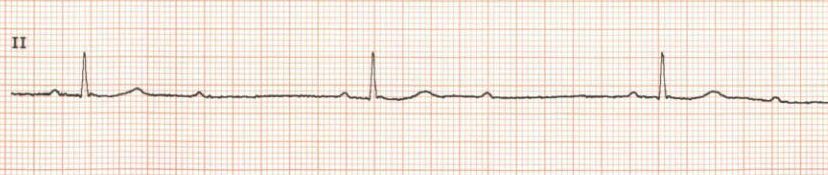 Mobitz type 2 heart block ECG rhythm strip